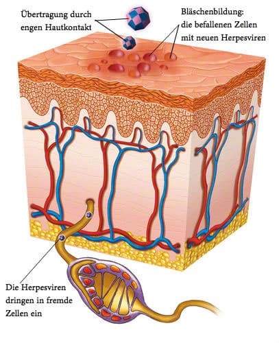 herpes ursachen