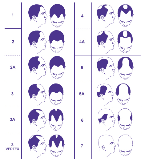Hårtab i 7 stadier hårtab i 7 stadier