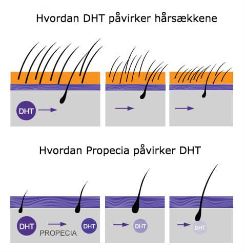 DHT og Propecia DHT og Propecia