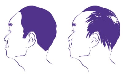 male-hair-loss-patern