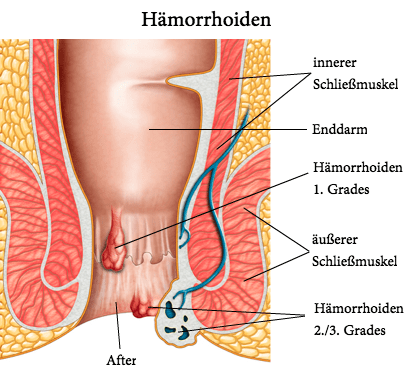 Hämorrhoiden