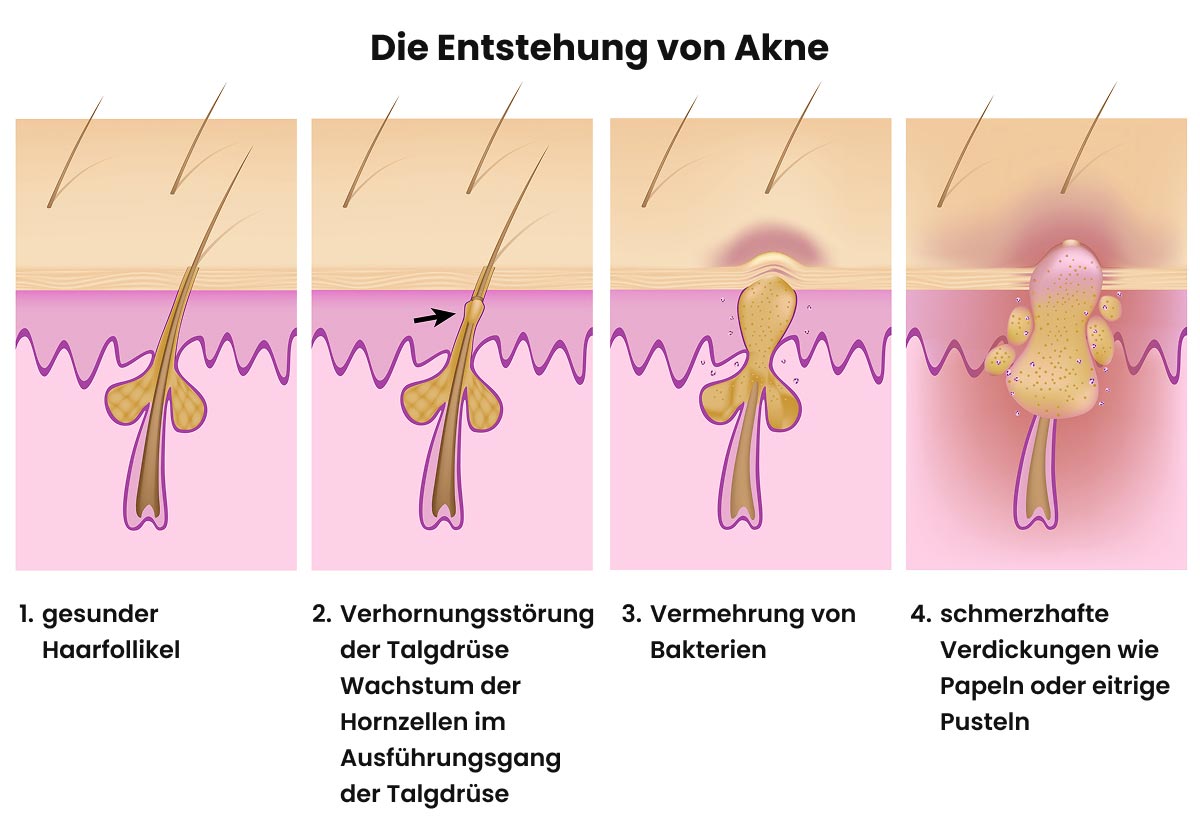 akne entstehung