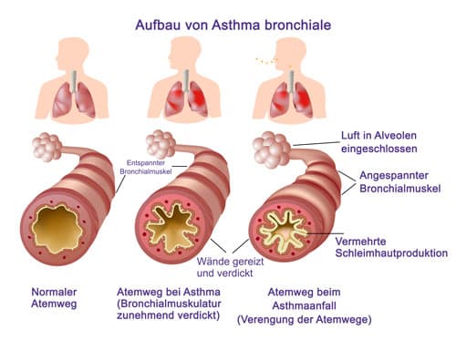 Asthma