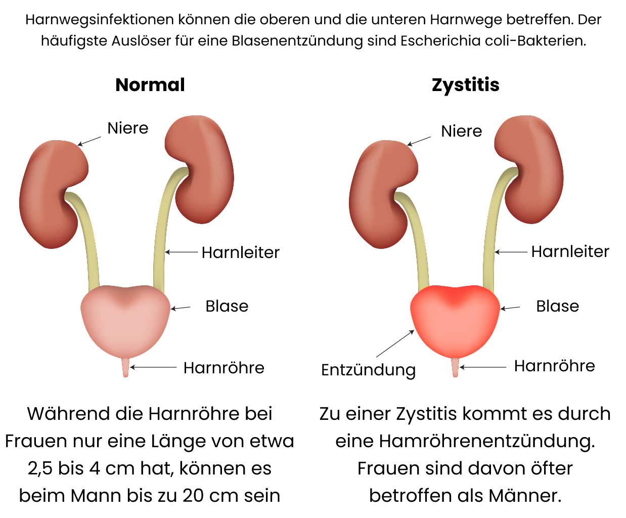 Blasenentzündung (akute Zystitis)