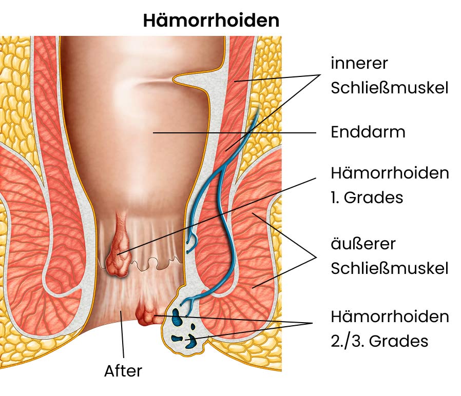 Hämorrhoiden