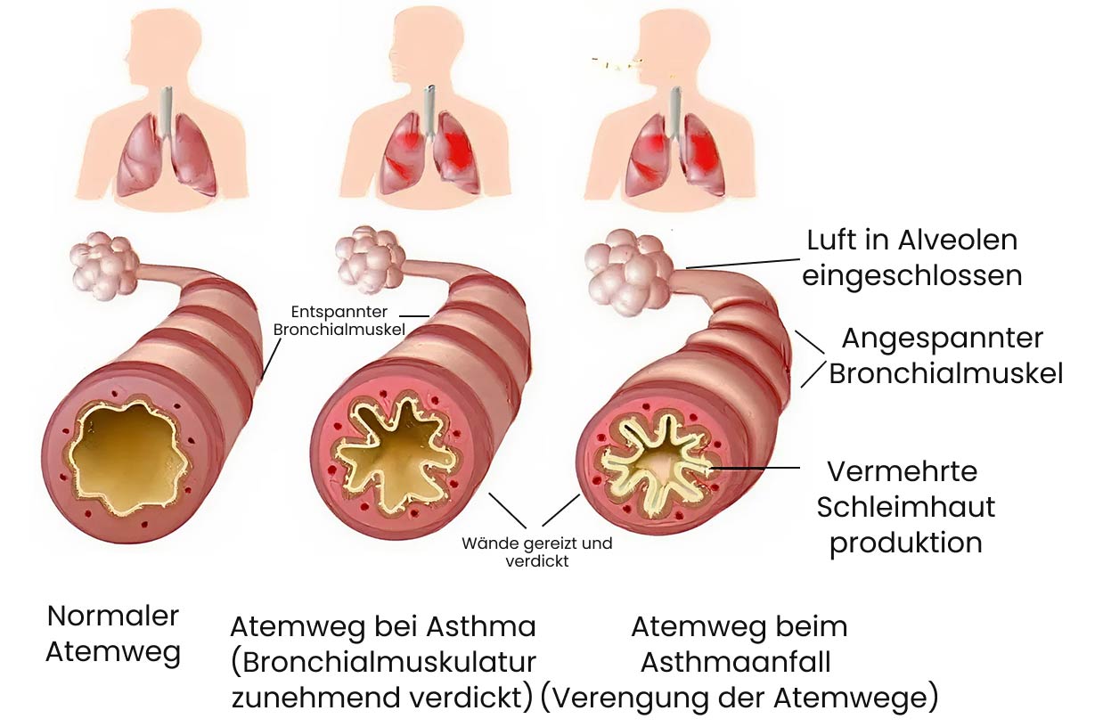 Aufbau von Asthma bronchiale