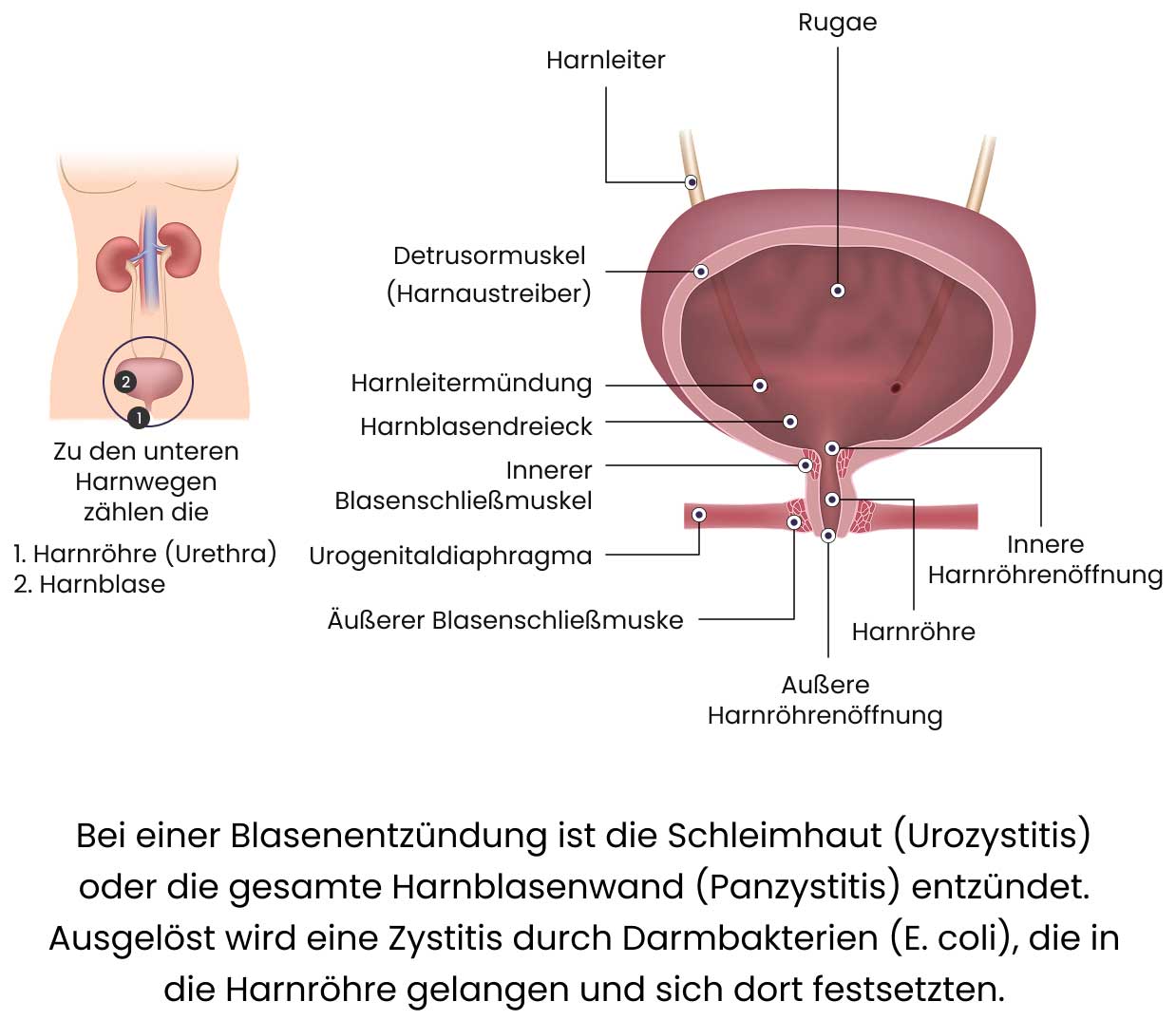 Die Entstehung einer Blasenentzündung (Zystitis)
