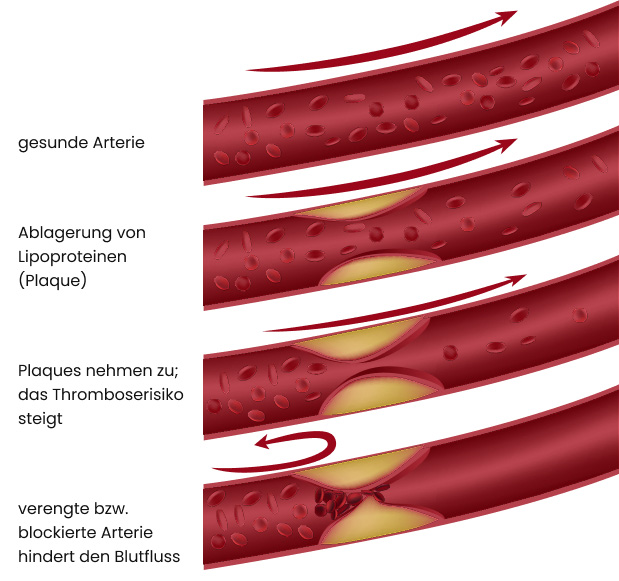 Die Entstehung einer Atherosklerose