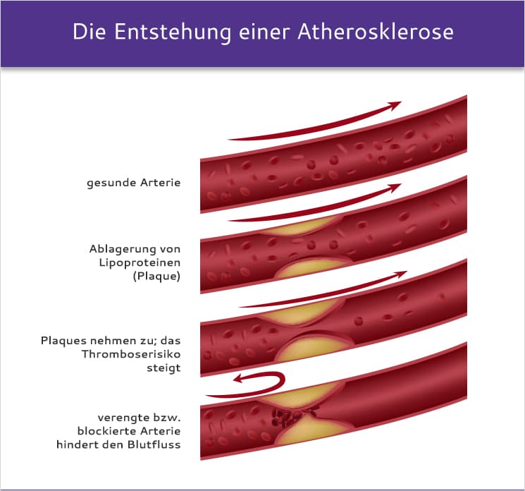 Entstehung einer Atherosklerose