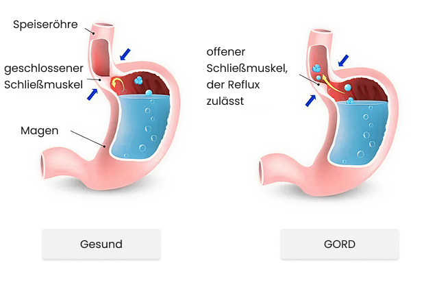 gastroösophageale Refluxkrankheit (GORD)