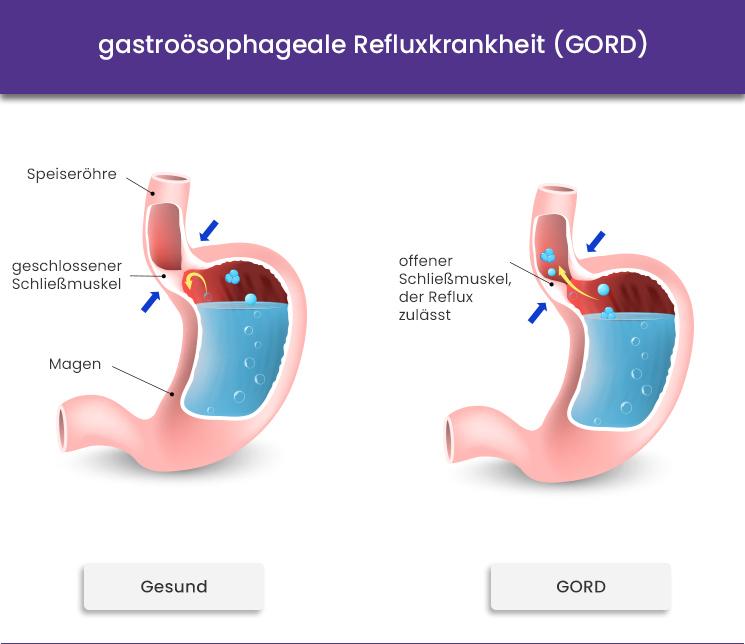 gastroösophageale Refluxkrankheit (GORD)
