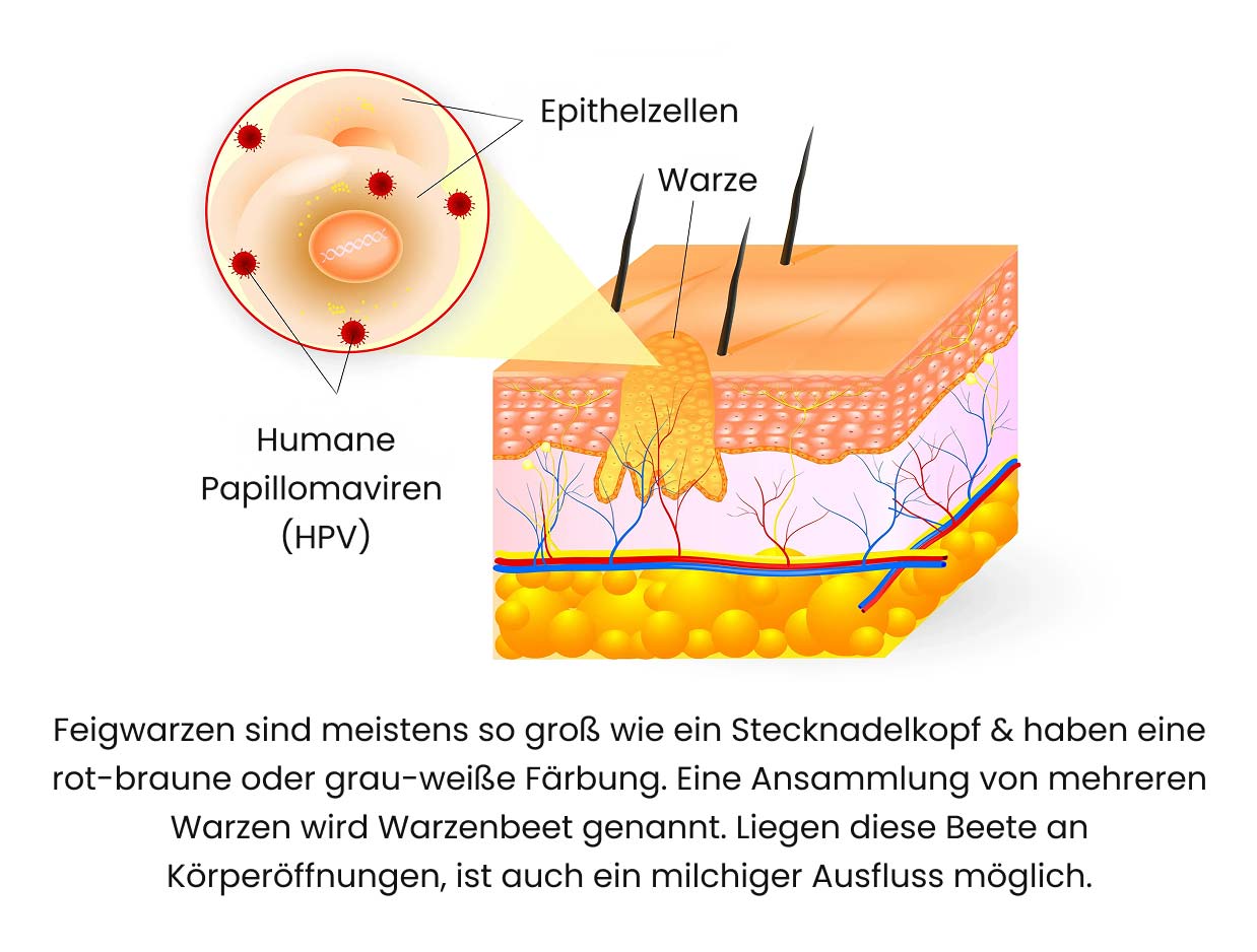 Aufbau von Genitalwarzen