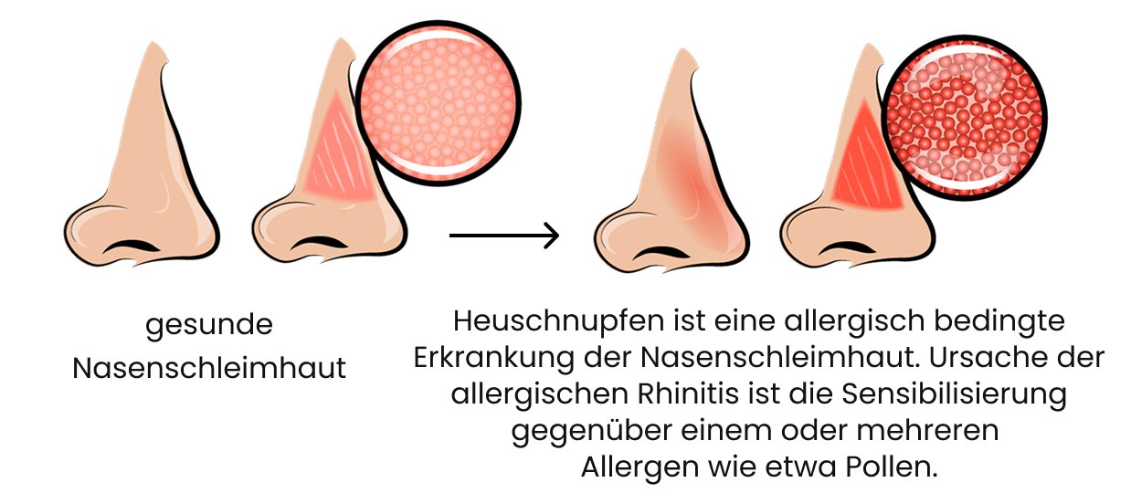 Heuschnupfen (pollenbedingte allergische Rhinitis)