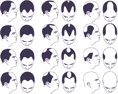 haarausfall bei männern