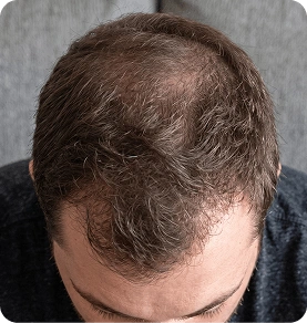 Haarausfall verlaufen