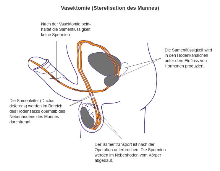 Samenleiter durchtrennen mann Vasektomie
