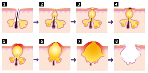 udvikling af bumser og akne