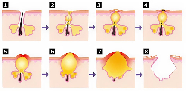 udvikling af bumser og akne