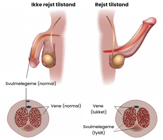 Hvordan_får_man_erektion