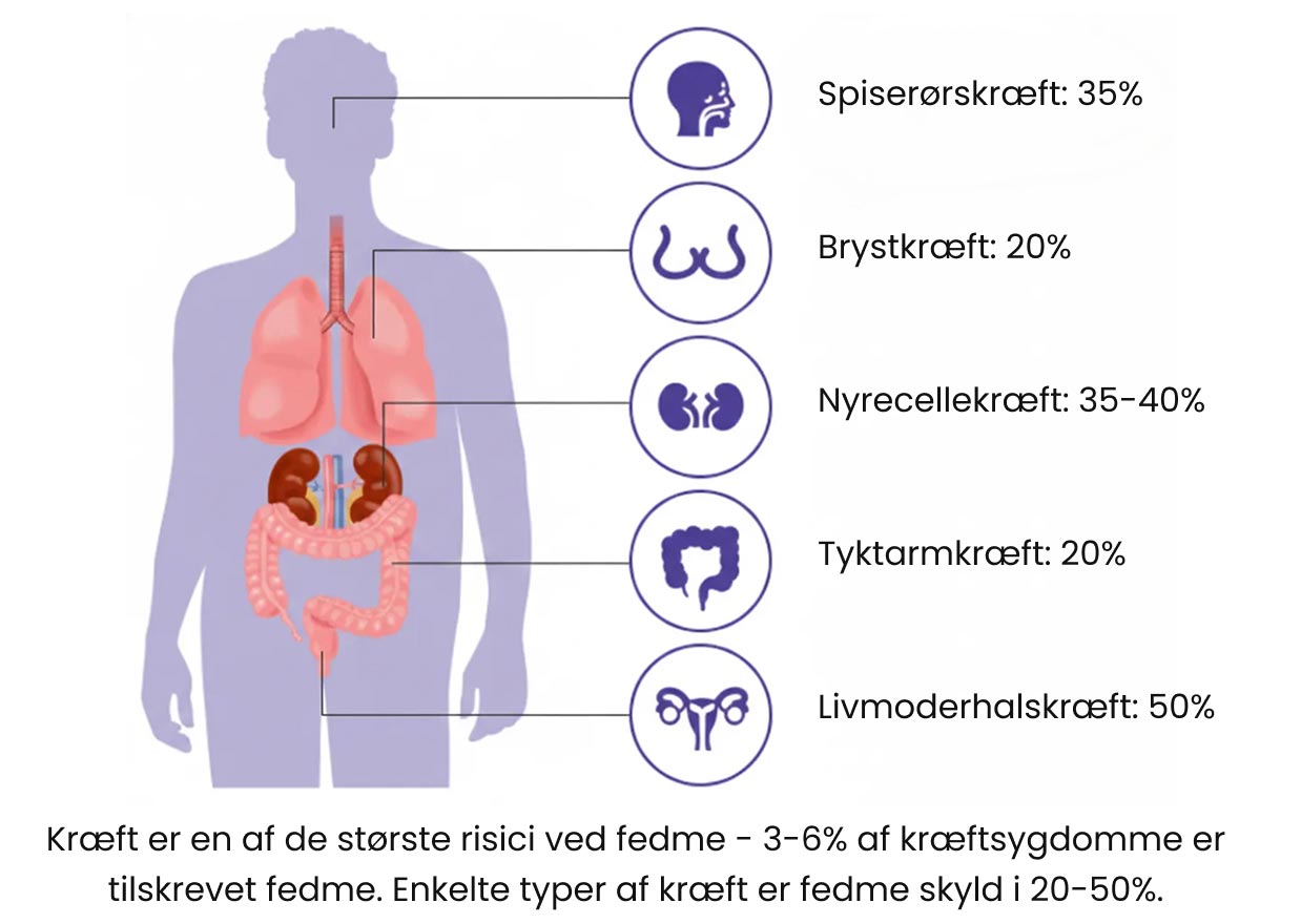 Øqet risiko for kræft ved overvægt