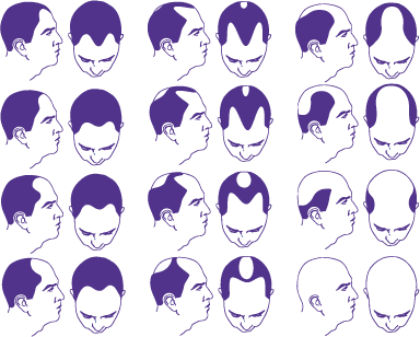 Hamiltons klassificering av håravfall