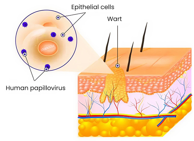 Structure of genital warts
