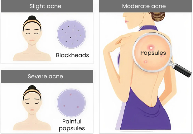 Symptoms the acne stages