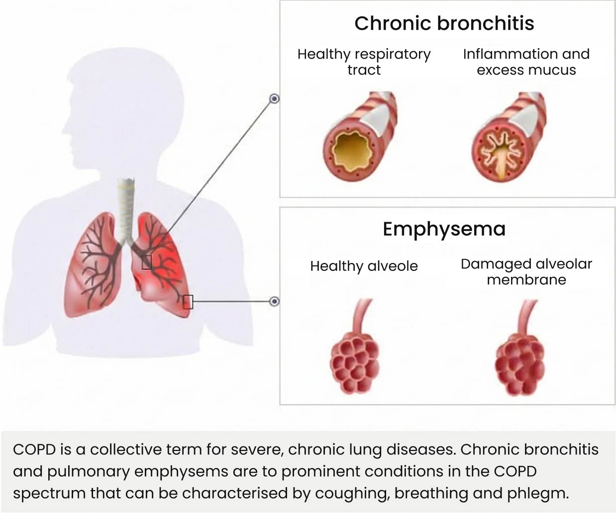 Chronic obstructive pulmonary disease