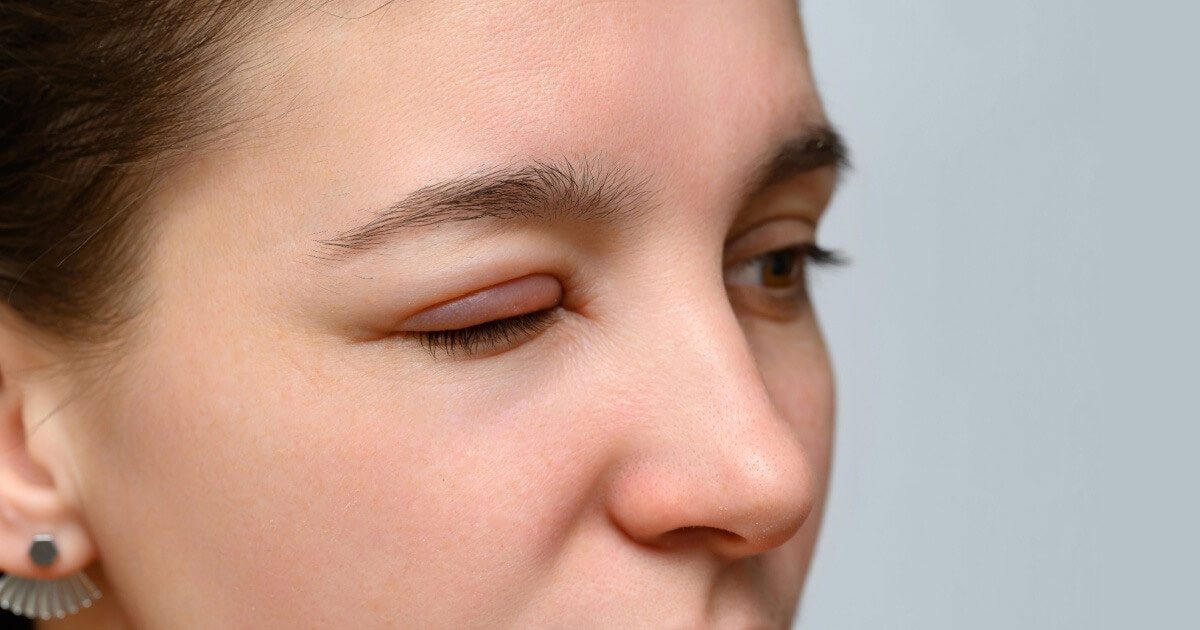 Close-up of a woman with a very swollen, puffy eyelid