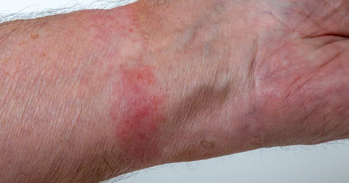 ᐅ A guide to eczema types • HealthExpress®