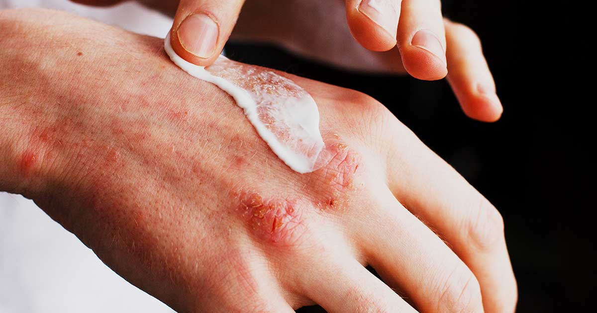 Close up of man’s hand applying cream to eczema. 