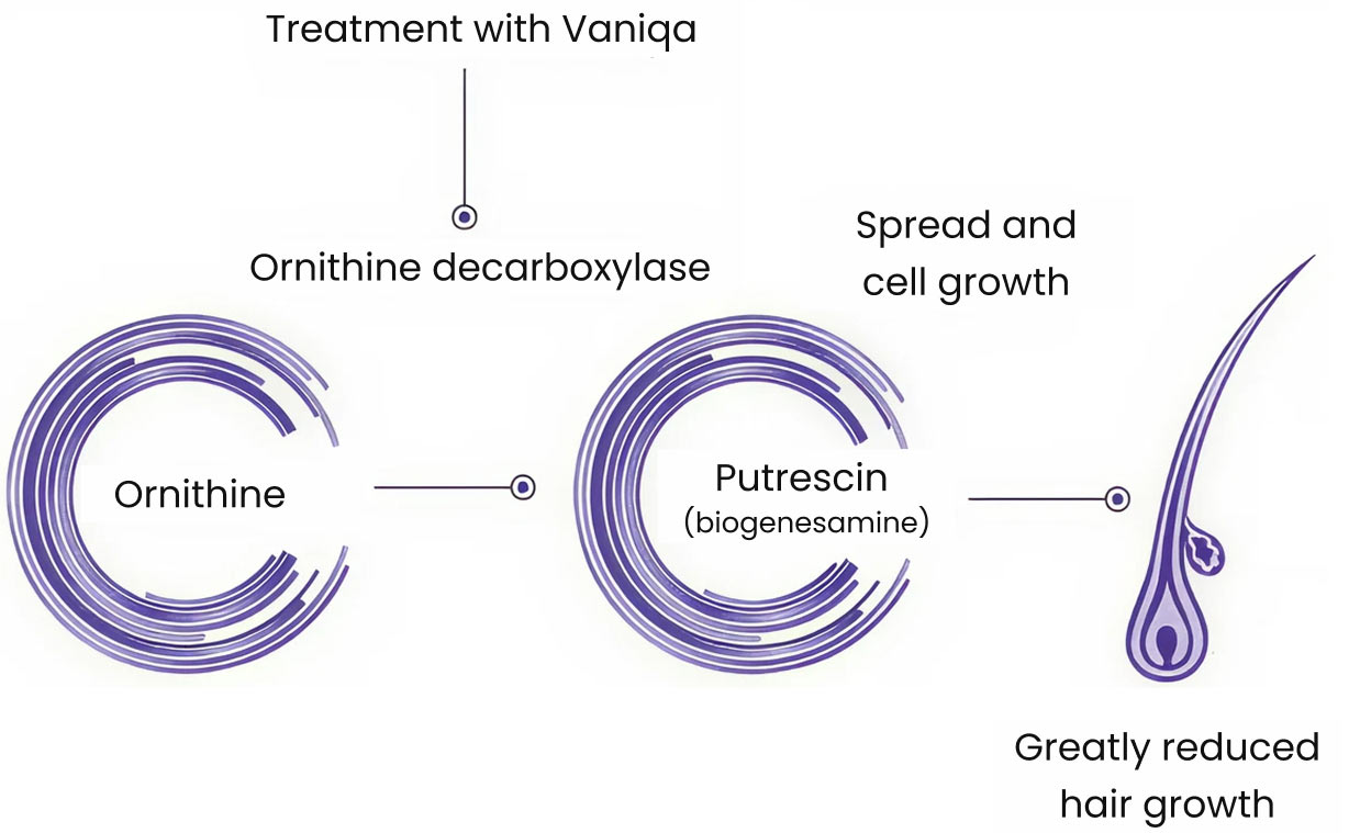 Effect of eflornithine in hirsutism