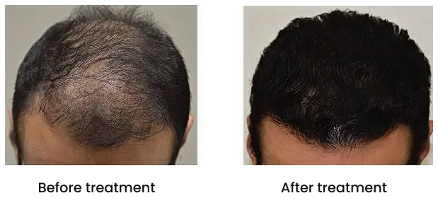 Effects of finasteride (Propecia)