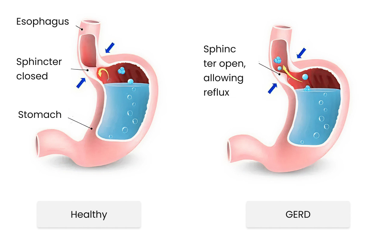 gastroesophageal reflux disease