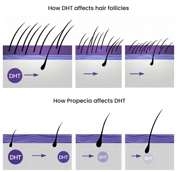 How DHT affects hair follicles  