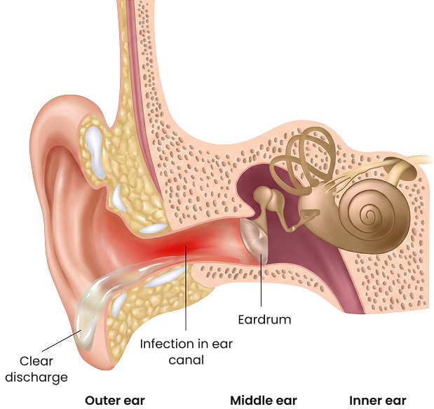 Infection of the ear canal