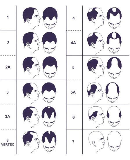 male-hair-loss-patern