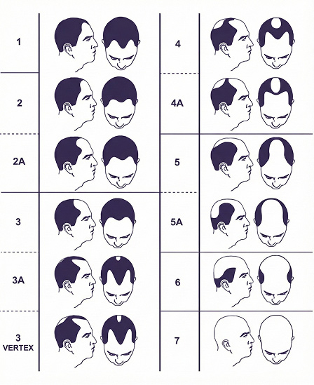 male-hair-loss-patern