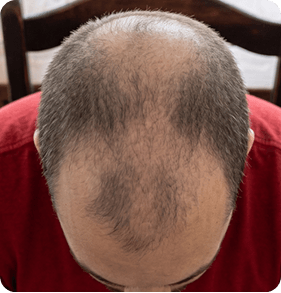 Month 0 hair