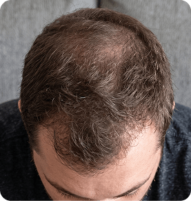 Month 12 hair